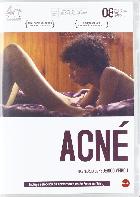 Acné